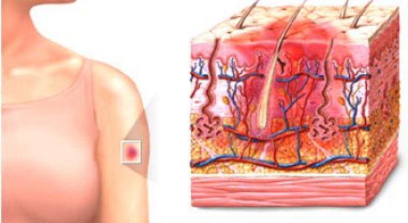 Subcutaneous bruise: bầm dưới da